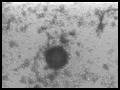 In Vitro Fertilization(IVF)