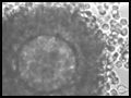 In Vitro Fertilization(IVF)